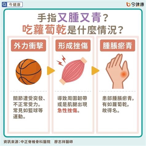 中指受傷|手指挫傷（俗稱：吃蘿蔔）